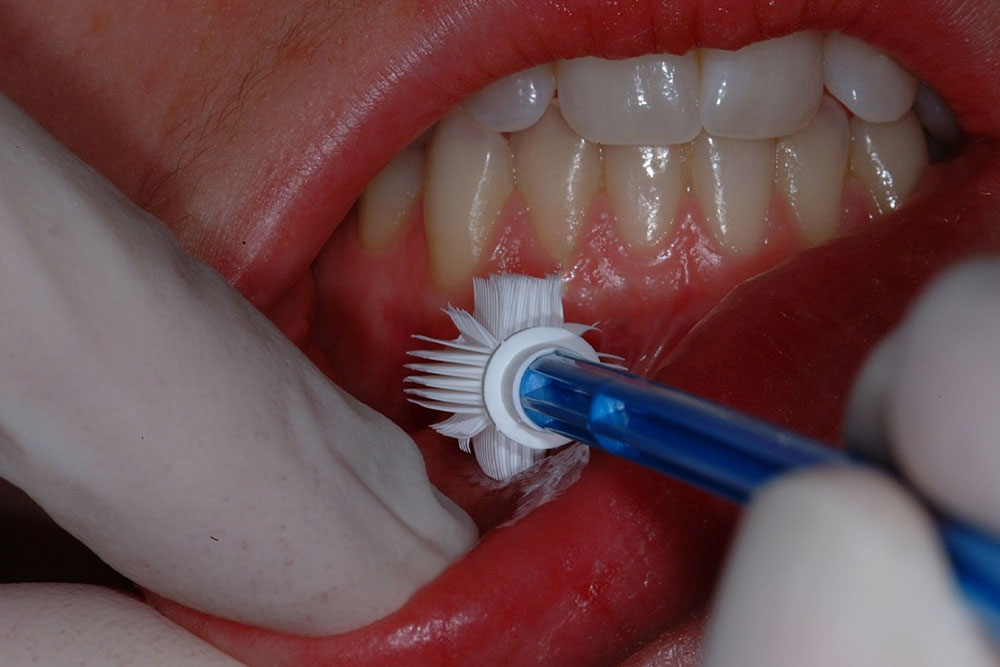 Brush biopsy in Raleigh, NC