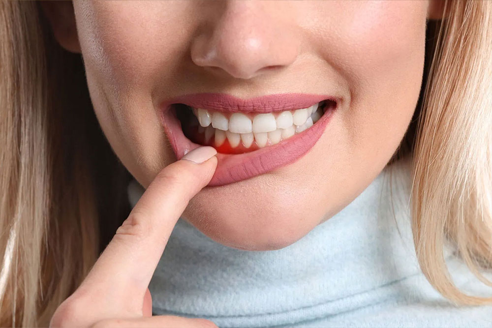 Gum treatment - Woman holding lip, exposing her gums