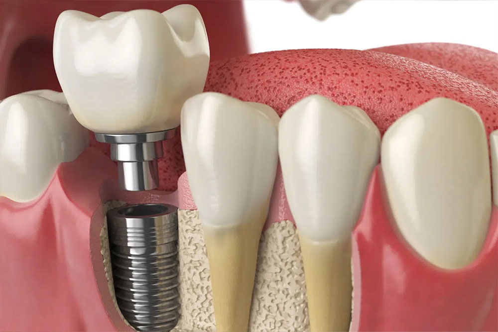Restorative dentistry illustration
