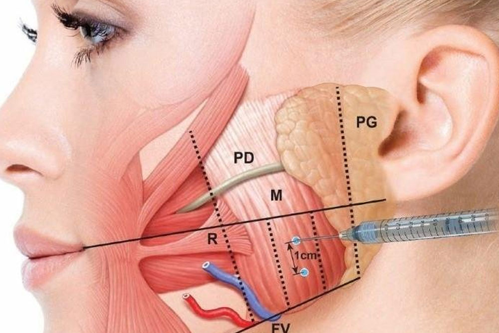 Diagram of woman getting botox treatment to help ease pain caused by TMJ syndrome